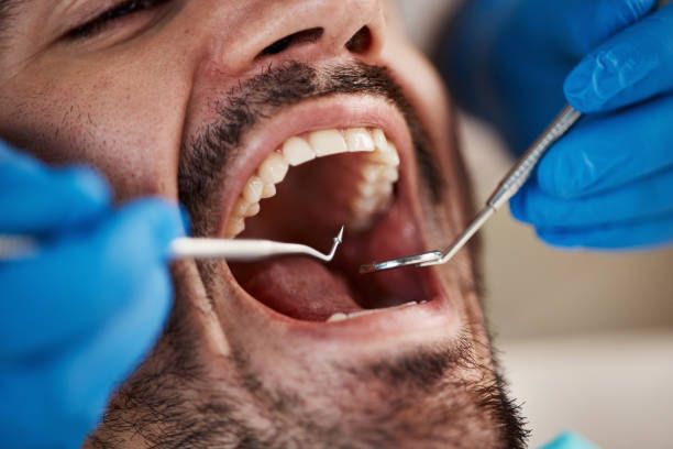 Best Emergency Wisdom Teeth Removal in Sea Breeze, NC